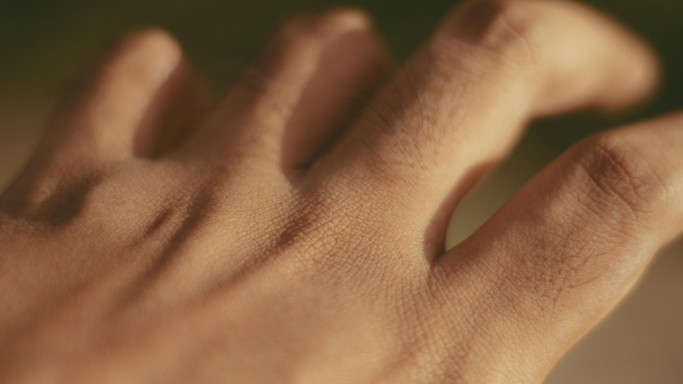 Tips Ampuh Mengatasi Kulit Belang Secara Alami