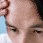Kulit Kering Akibat Skin Barrier Rusak: Penyebab dan Penjelasannya