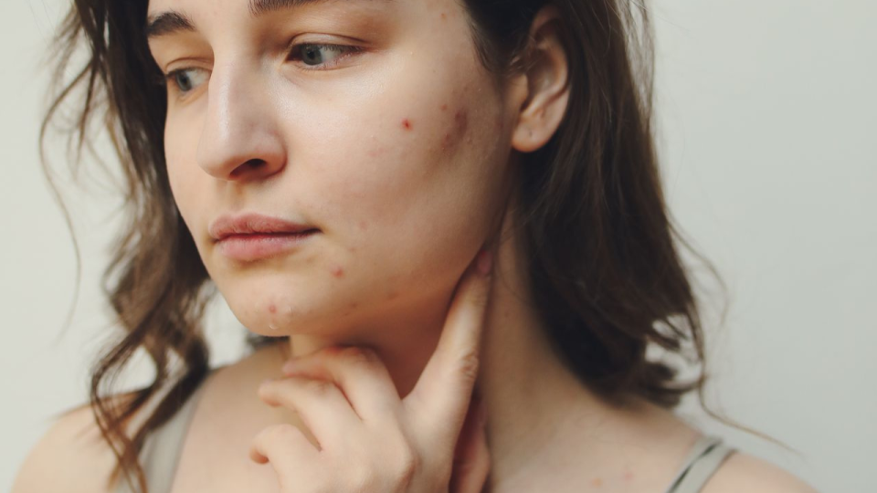 Tanda Awal Proses Pemulihan Skin Barrier