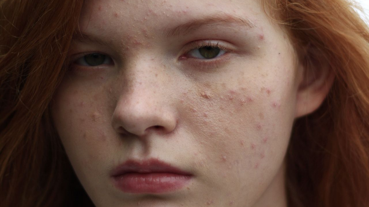 Breakout Setelah Pakai Skincare? Belum Tentu Karena Produk Tidak Cocok