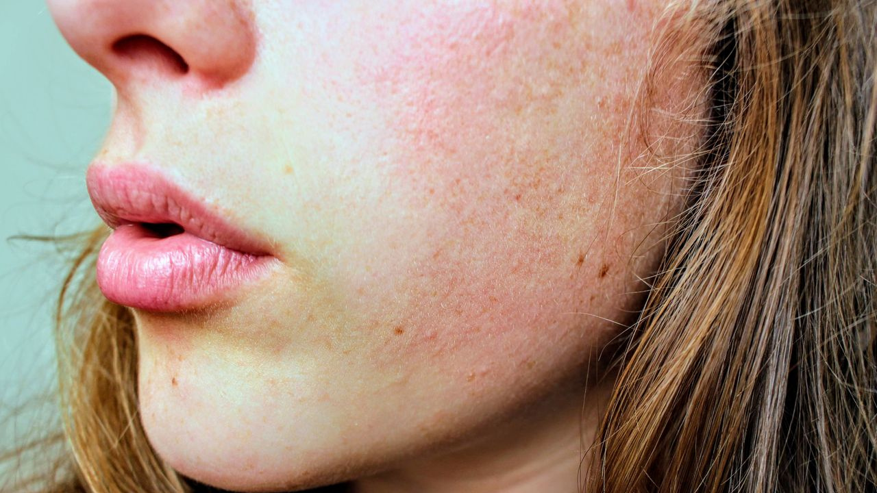 Skincare Terasa Perih? Bisa Jadi Skin Barrier Kamu Sedang Terganggu
